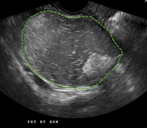 Ovarian Dermoid Cyst Collection Of Ultrasound Images