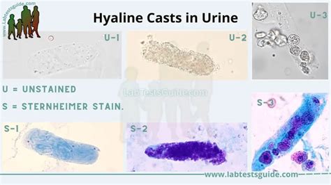 Hyaline Casts Definition Causes Significance And Clinical Correlations