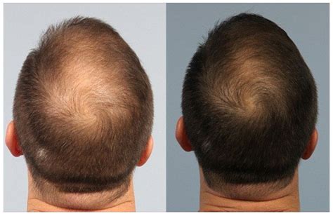 Prp Before And After Platelet Rich Plasma Reviews Prp Injection Md