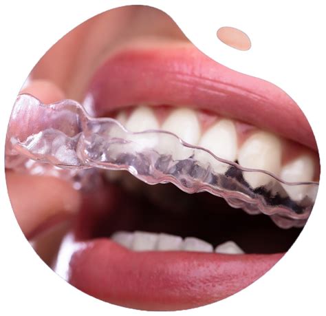 Clear Dental Aligners Carrollton Tx Invisible Teeth Straightening