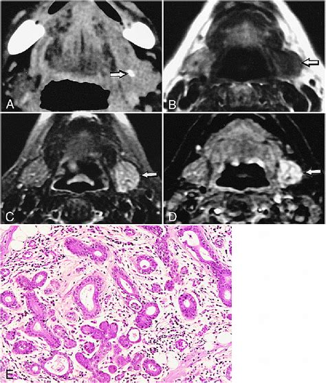 The Mr Imaging Assessment Of Submandibular Gland Sialoadenitis