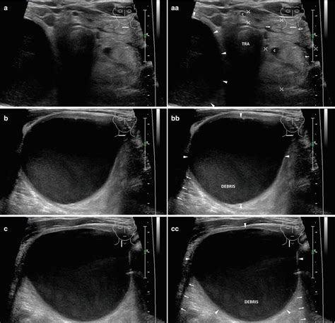 Thyroid Cysts Radiology Key