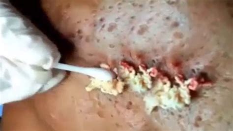 How To Get Rid Of Blackheads Very Juicy Pimple Popping Biggest Cyst