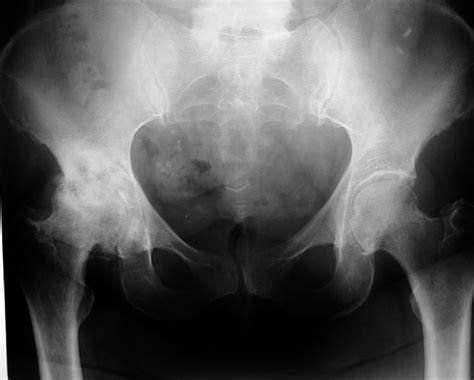 Radiograph Of Osteoarthritis In Right Hip Joint With Moderate Loss Of