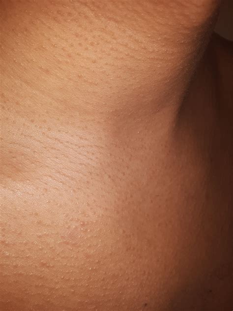 Skin Concerns Tiny Bumps On My Neck And Upper Chest Area Not Sure If