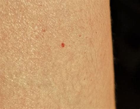Tiny Red Spots On Skin 30f Raskdocs