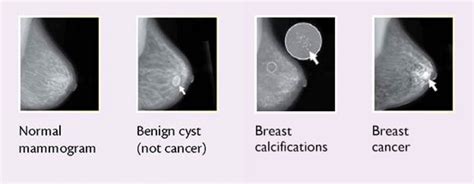 Pictures Of Breast Cancer Lumps How To Identify Warning Signs