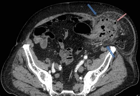 The Axial Contrast Media Ct Mdct Image Well Show The Spigelian