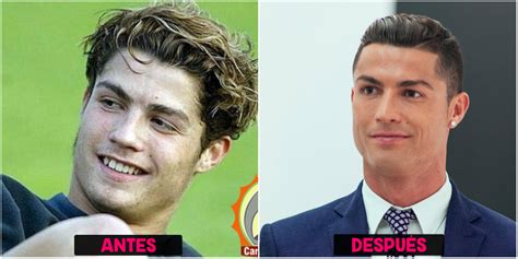 Cirugías de Cristiano Ronaldo Antes y después Cirugias de