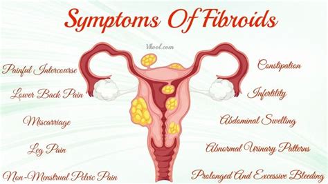 25 Bästa Fibroids In Uterus Idéerna På Pinterest