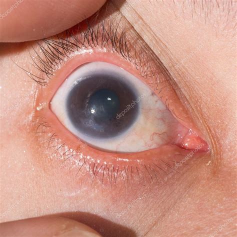 Keratitis During Eye Examination Stock Photo By Arztsamui 106589732