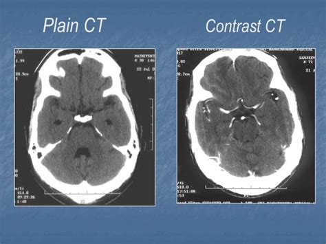 What Is Ct With Contrast Omega Pds
