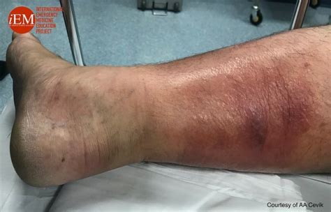 Cellulitis Clinical Image And Ultrasound International Emergency