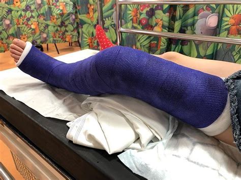 In Honour Of Prince My Daughter Opted For A Purple Cast Having Watched