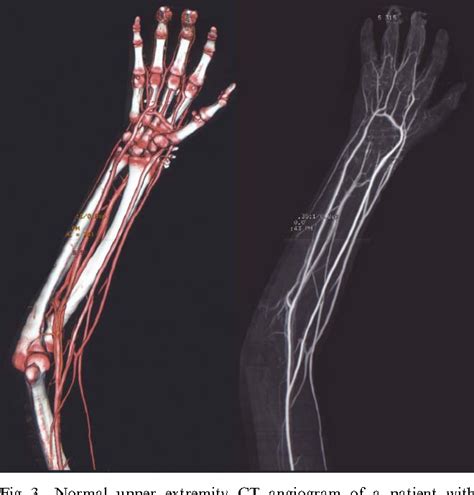 Figure 3 From Ct Angiography In Complex Upper Extremity Reconstruction