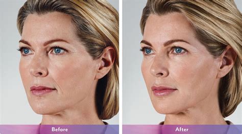 JuvÉderm Vollure Xc For Wrinkle Injections In Washington Dc Mi Skin