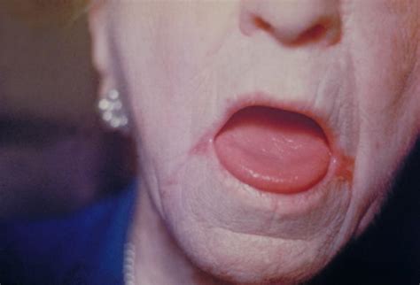 Oral Thrush Pictures 1 Hardin Md Cdc