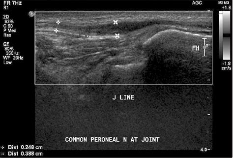 Sagittal Section Of Ultrasound Sonography Showed Normal Common