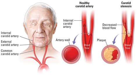 Intracranial Artery Stenosis Treatment Mapasgmaes