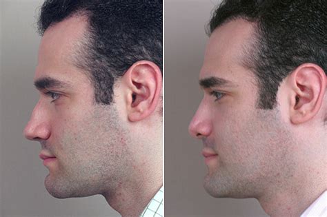 Were you exercising before your plastic surgery, or do you want to start? Male Rhinoplasty Patient 3 - Parker Center for Plastic Surgery