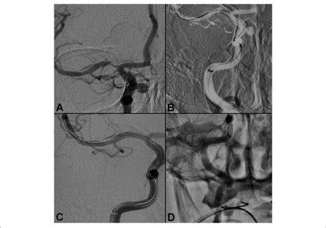 Right Middle Cerebral Artery Stenosis A Pre Procedure Angiogram