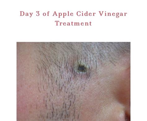 How To Remove A Mole With Apple Cider Vinegar Musely