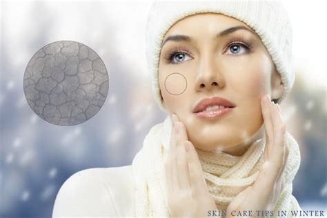 Keeping Your Skin Healthy In The Winter Ch Edwards Inc