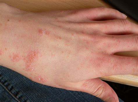 Scabies Pictures And Symptoms