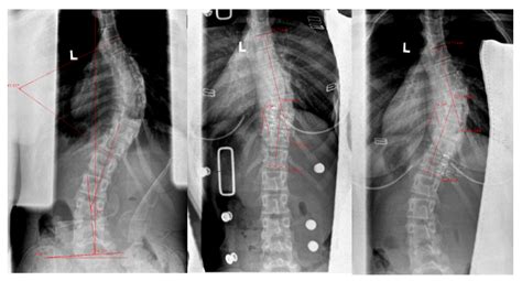 Severe Scoliosis A Guide To Nonsurgical Treatment Options