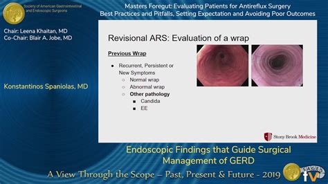 Endoscopic Findings That Guide Surgical Management Of Gerd Youtube