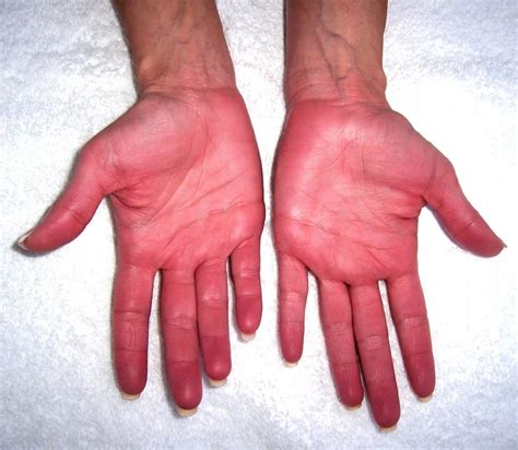 Красные ладони рук Признак какой болезни причины чего у взрослого