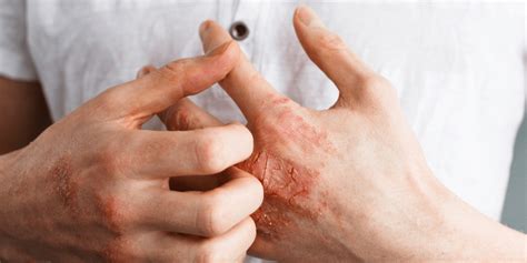 Eczema Symptoms Causes And Treatment Affiliated Dermatology