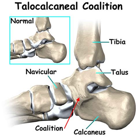 Tarsal Coalition Causes Symptoms Diagnosis And Treatment