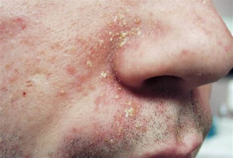 Seborrheic Dermatitis On Face Pictures Symptoms And Pictures