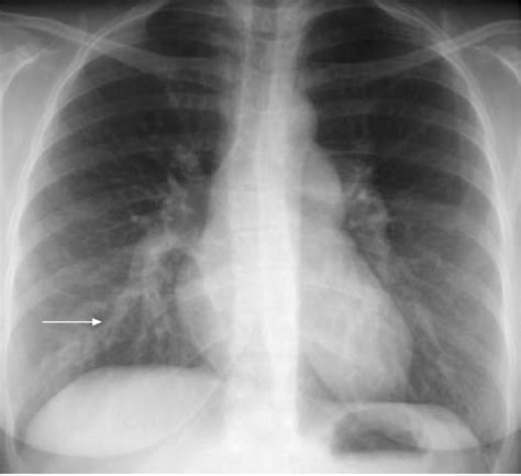 Chest Radiograph Revealed Enlargement Of The Two Pulmonary Arteries And