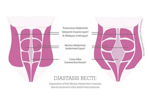 Diastasis Recti The Muscles Mutu System
