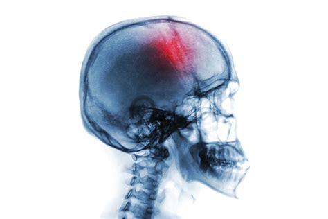 Treating Acquired Brain Injury With Noninvasive Brain Stimulation