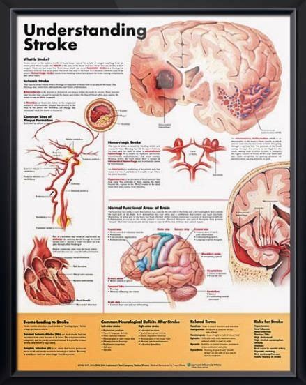 Understanding Stroke Neurology Nurse
