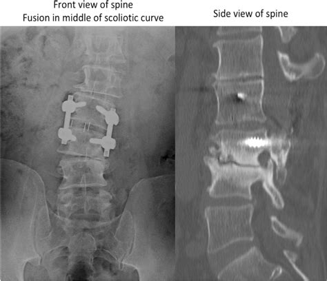 Revision Spine Surgery And Complex Spine Surgery Rocky Mountain Brain
