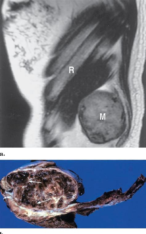Figure 7 From Chest Wall Tumors Radiologic Findings And Pathologic