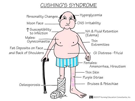 Abc Medicine Cushings Syndrome Nursing School Pinterest Cushing