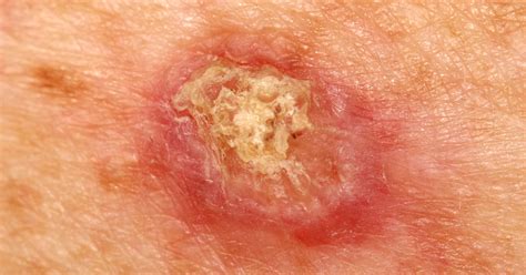 Early Squamous Cell Skin Cancer Signs