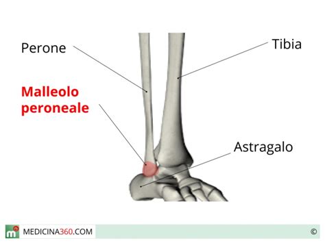 Frattura malleolo peroneale: tipi, cause, terapia e ...