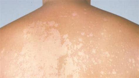 Small White Spots On Skin Great Save 43 Jlcatj Gob Mx
