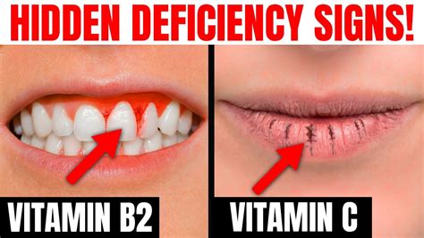 8 Hidden Signs Your Body Is Deficient In Nutrients Youtube
