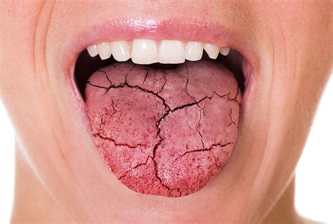 causes of dry mouth and what you can do dr kami hoss