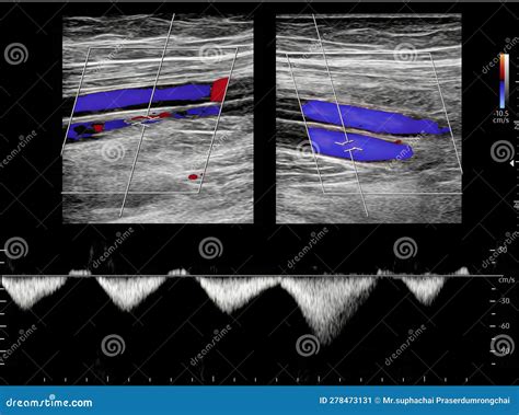Color Doppler Ultrasound Determination In Deep Vein Thrombosis Patients