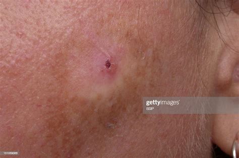 Bowenoid Actinic Keratosis And Focus Of A Superficial Basal Cell