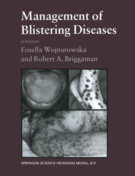 Management Of Blistering Diseases 9780412289903 Robert A Briggaman
