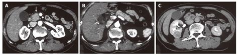 Pyogenic Liver Abscess After Choledochoduodenostomy For Biliary